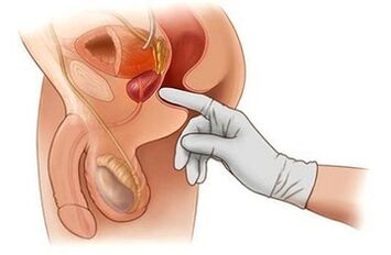 Masque prostate