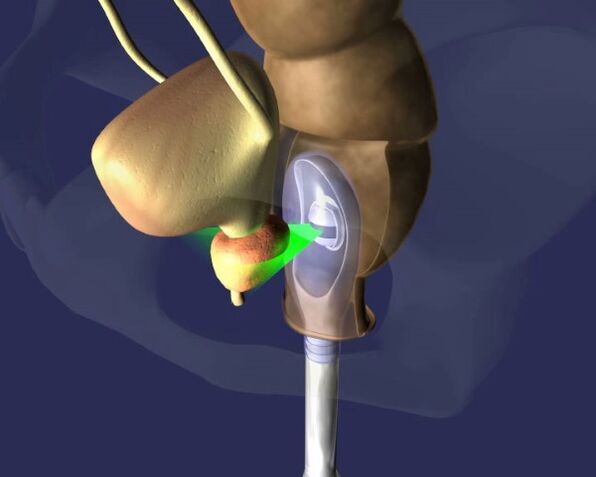 traitement par ultrasons de la prostate pour la prostatite