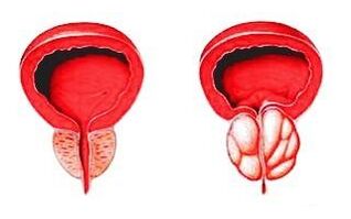 Prostate dans des conditions normales (à gauche) et enflammée par une prostatite (à droite)